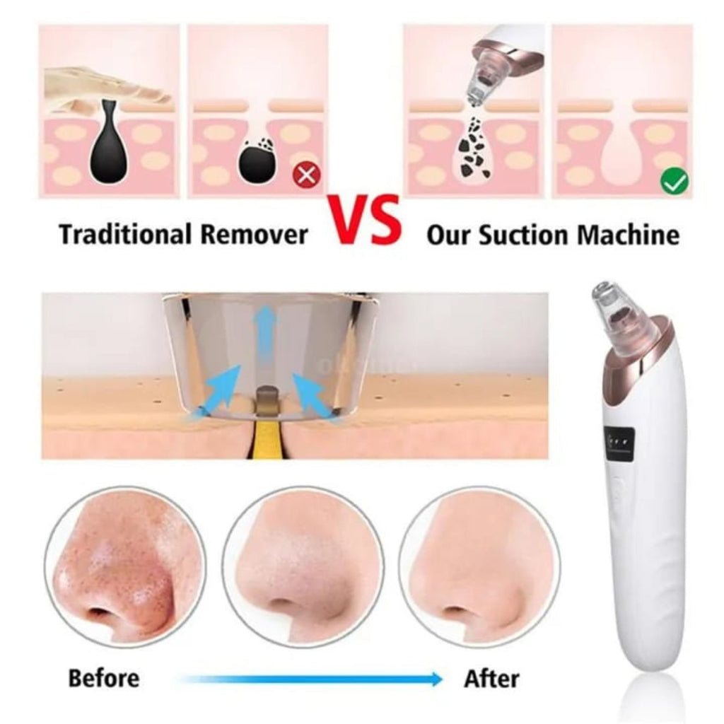 5-in-1 electric blackhead remover with vacuum suction for deep pore cleaning.